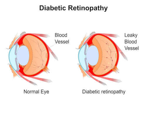 Diabetic Retinopathy Surgeon San Jose Ca